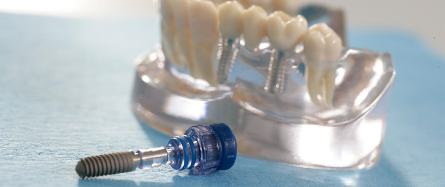Ein Implantat ist der beste Ersatz für den eigenen Zahn